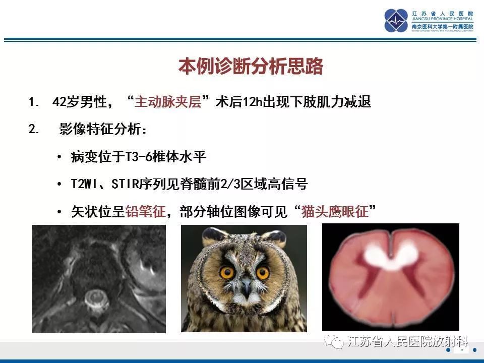 影像PPT - 【病例】脊髓梗死—脊髓前动脉综合征1例MR-22