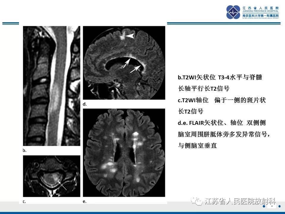 影像PPT - 【病例】脊髓梗死—脊髓前动脉综合征1例MR-25