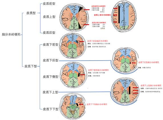 影像PPT - 脑分水岭梗死的解剖和分型-5 影像PPT - 脑分水岭梗死的解剖和分型-5