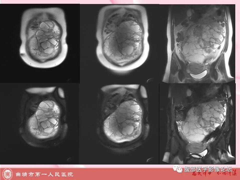 影像PPT - 【病例】卵巢黄素化卵泡膜细胞瘤1例MR-3