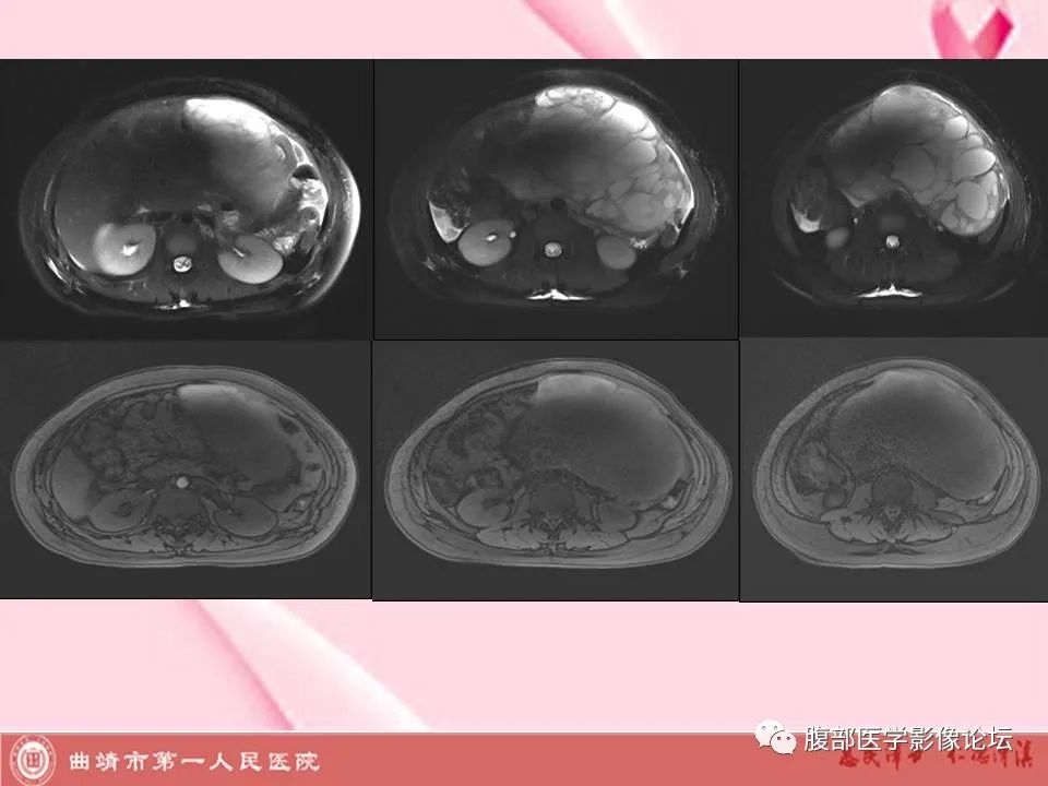 影像PPT - 【病例】卵巢黄素化卵泡膜细胞瘤1例MR-4
