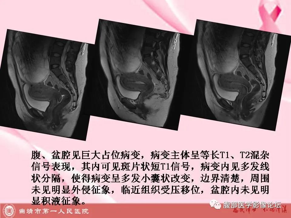 影像PPT - 【病例】卵巢黄素化卵泡膜细胞瘤1例MR-5
