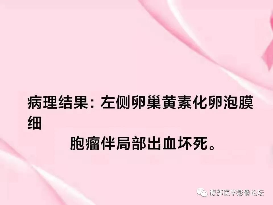 影像PPT - 【病例】卵巢黄素化卵泡膜细胞瘤1例MR-8
