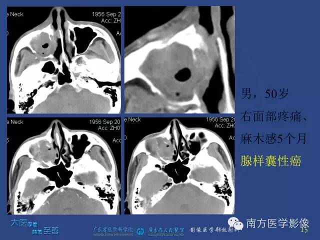 影像PPT - 【PPT】鼻腔鼻窦腺样囊性癌-6