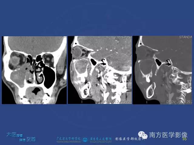 影像PPT - 【PPT】鼻腔鼻窦腺样囊性癌-7