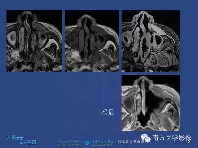 影像PPT - 【PPT】鼻腔鼻窦腺样囊性癌-9