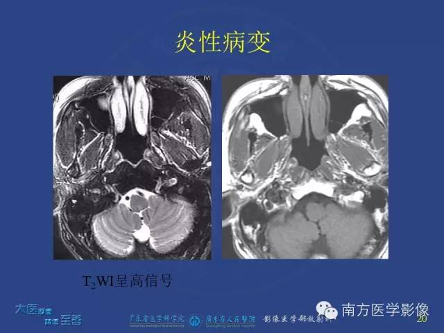 影像PPT - 【PPT】鼻腔鼻窦腺样囊性癌-11
