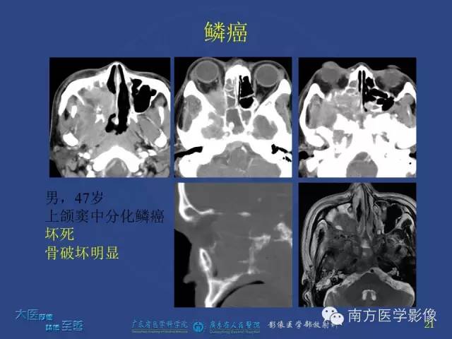 影像PPT - 【PPT】鼻腔鼻窦腺样囊性癌-12