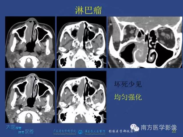 影像PPT - 【PPT】鼻腔鼻窦腺样囊性癌-13