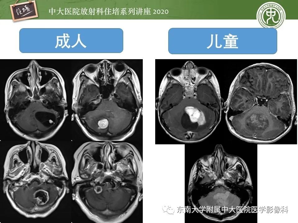 影像PPT - 【PPT】小脑占位的影像分析思路-2
