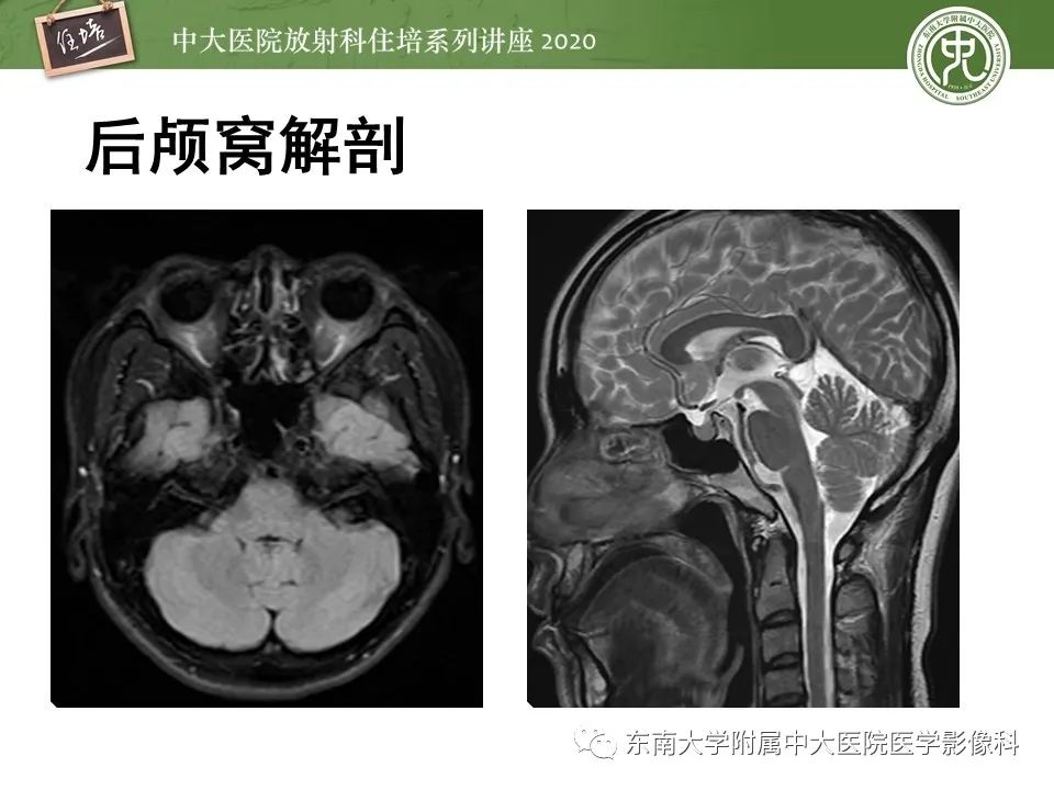 影像PPT - 【PPT】小脑占位的影像分析思路-3