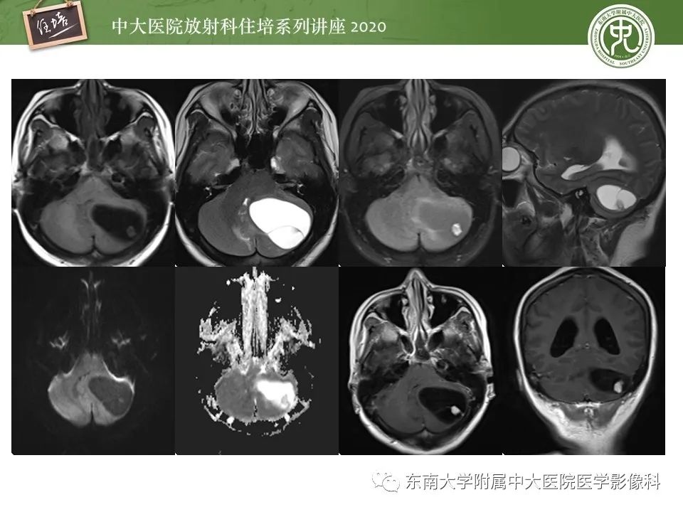 影像PPT - 【PPT】小脑占位的影像分析思路-8