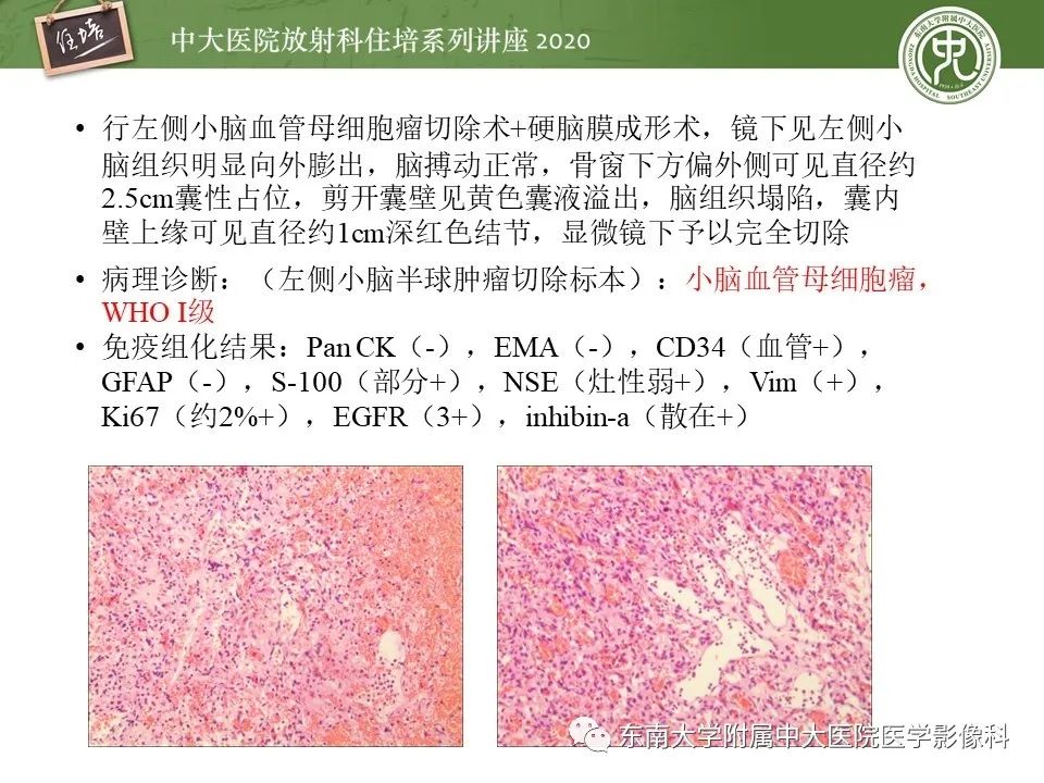 影像PPT - 【PPT】小脑占位的影像分析思路-9