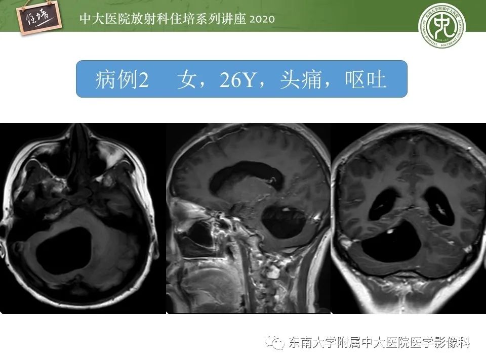 影像PPT - 【PPT】小脑占位的影像分析思路-16