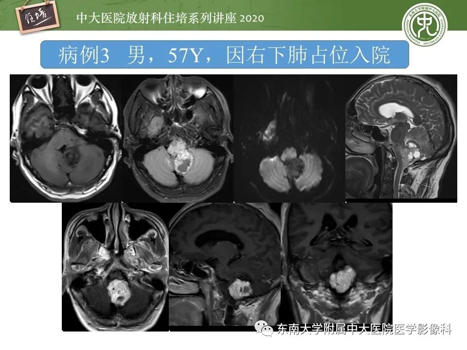 影像PPT - 【PPT】小脑占位的影像分析思路-17