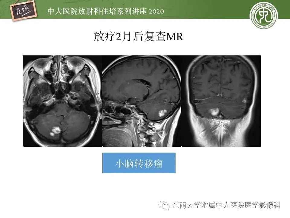 影像PPT - 【PPT】小脑占位的影像分析思路-21