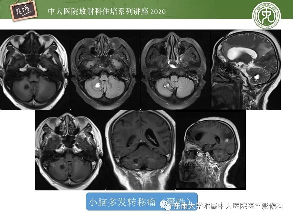 影像PPT - 【PPT】小脑占位的影像分析思路-25