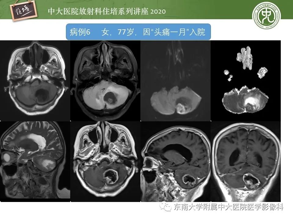 影像PPT - 【PPT】小脑占位的影像分析思路-26