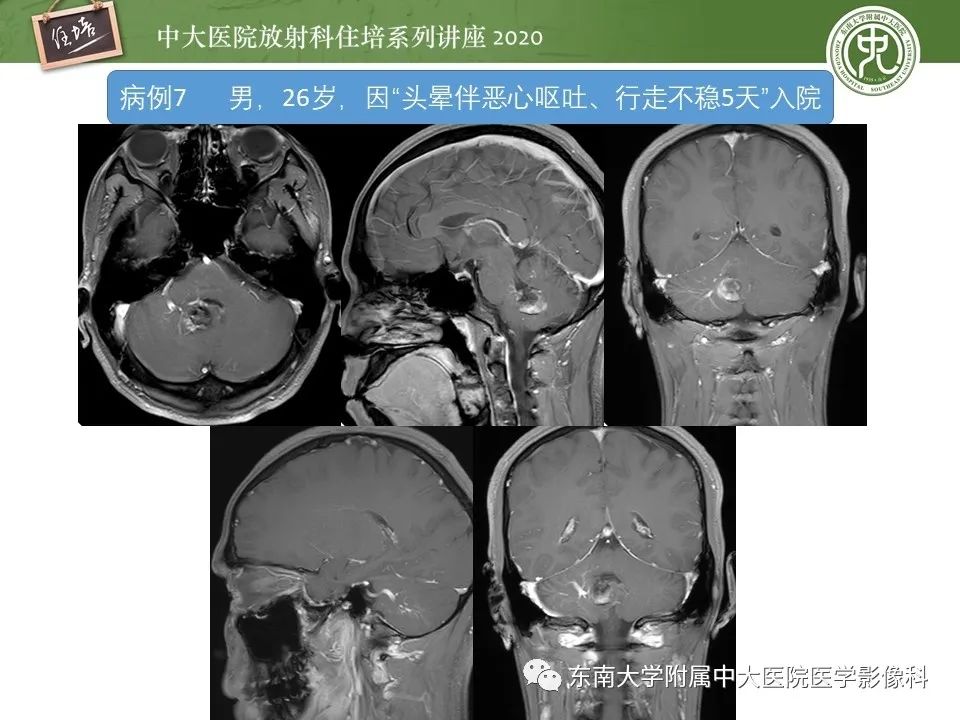 影像PPT - 【PPT】小脑占位的影像分析思路-29