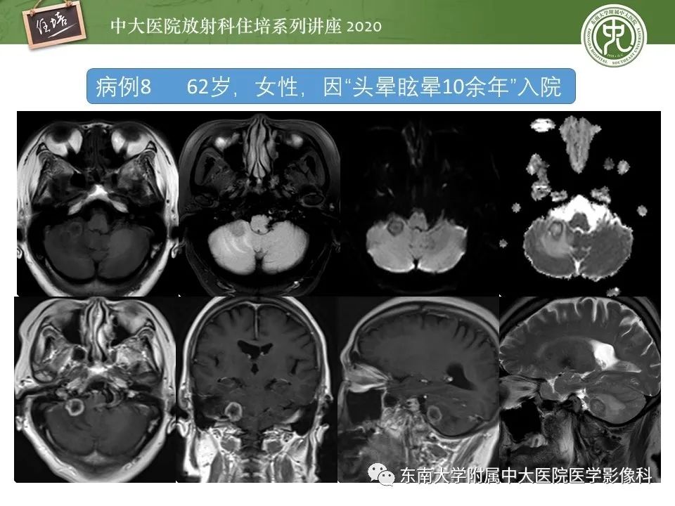 影像PPT - 【PPT】小脑占位的影像分析思路-31