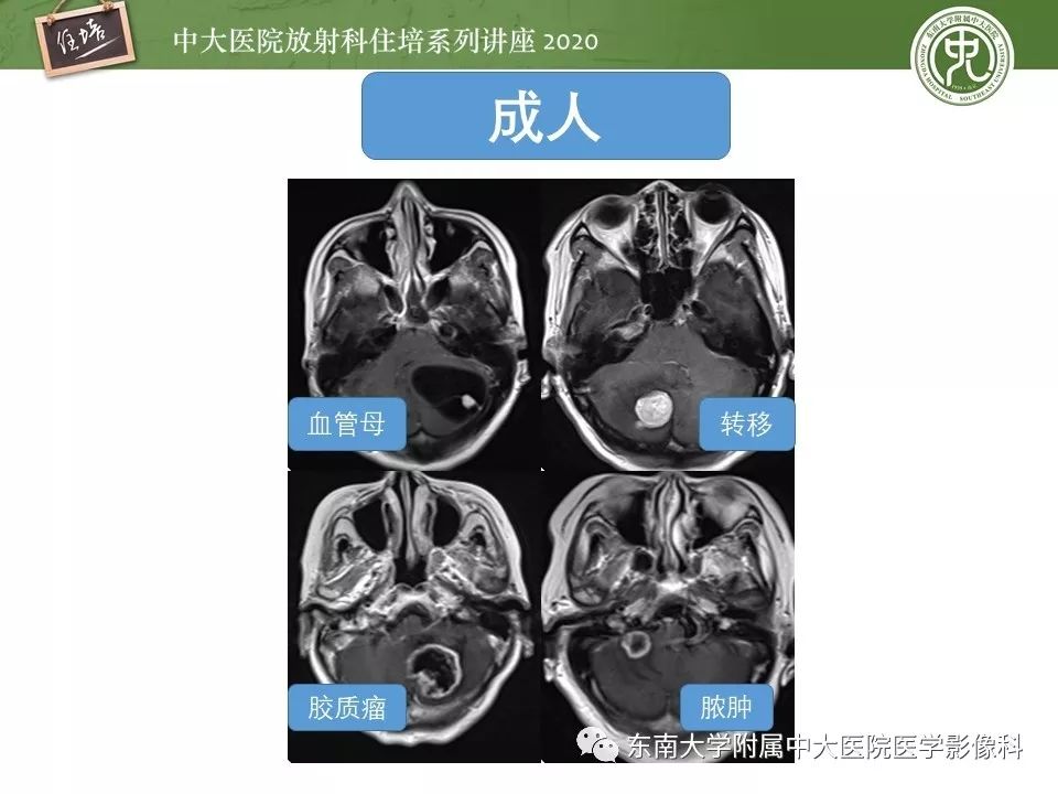 影像PPT - 【PPT】小脑占位的影像分析思路-33