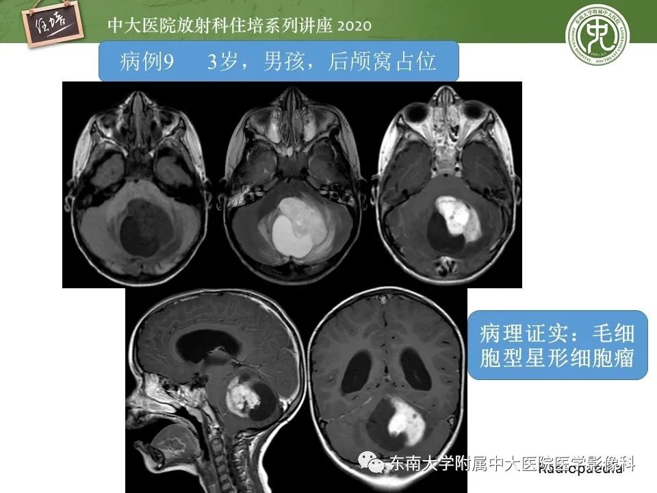 影像PPT - 【PPT】小脑占位的影像分析思路-34