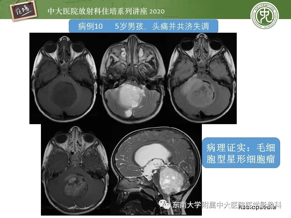 影像PPT - 【PPT】小脑占位的影像分析思路-37