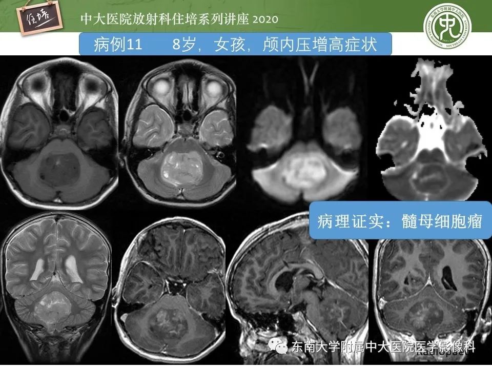 影像PPT - 【PPT】小脑占位的影像分析思路-38