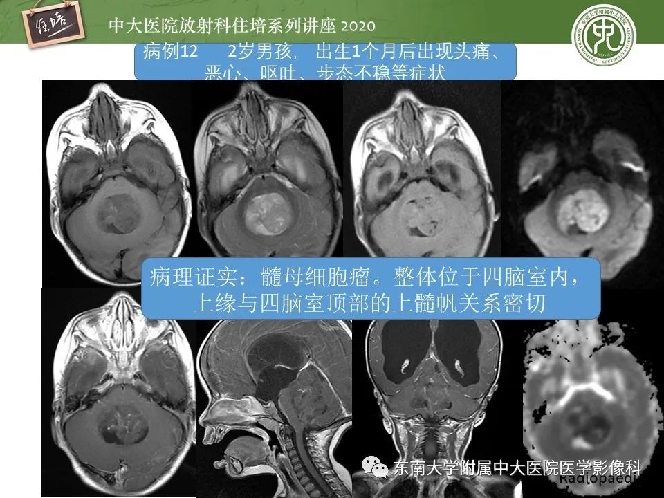 影像PPT - 【PPT】小脑占位的影像分析思路-41