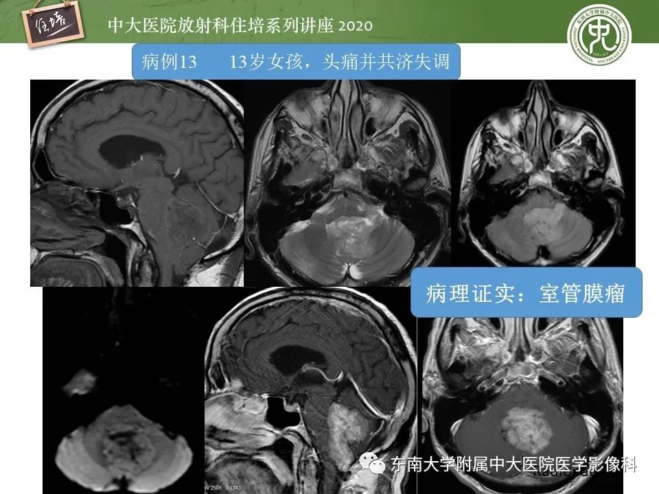 影像PPT - 【PPT】小脑占位的影像分析思路-42