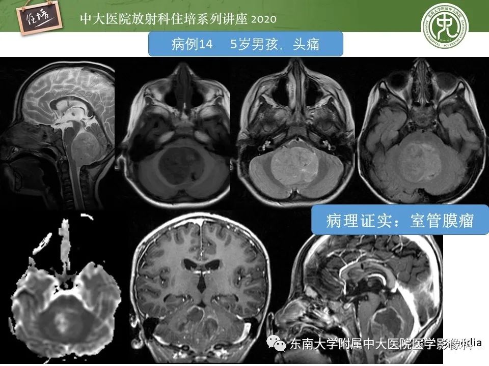 影像PPT - 【PPT】小脑占位的影像分析思路-45