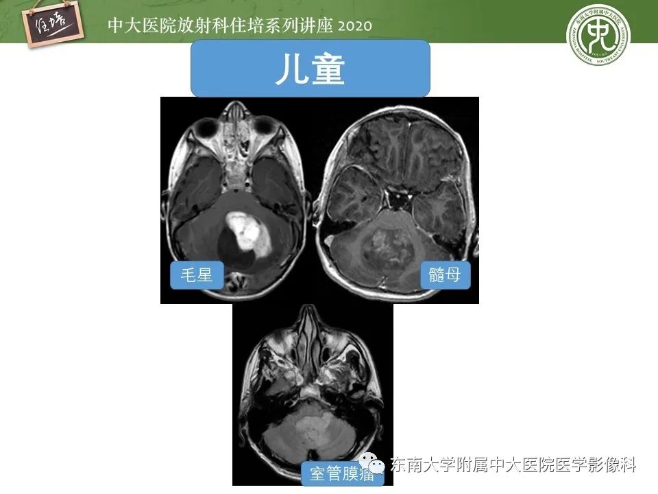 影像PPT - 【PPT】小脑占位的影像分析思路-47
