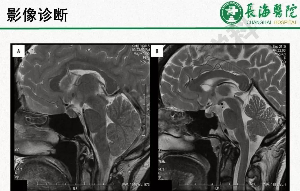 影像PPT - 【PPT】低颅压综合征-23