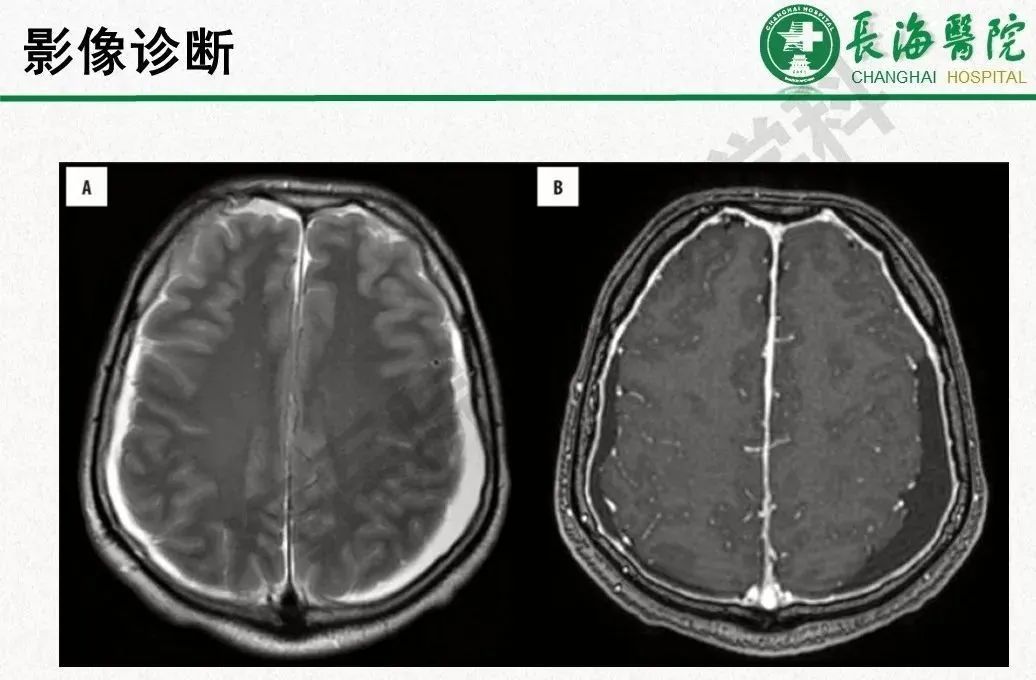 影像PPT - 【PPT】低颅压综合征-25