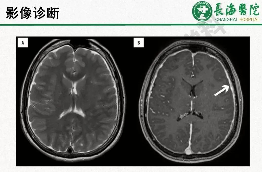 影像PPT - 【PPT】低颅压综合征-27