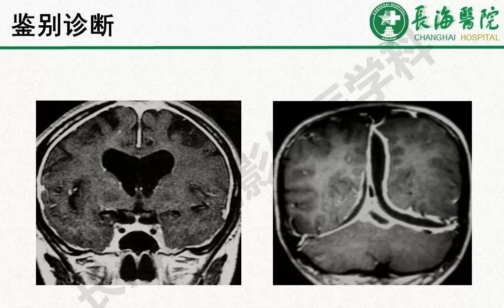 影像PPT - 【PPT】低颅压综合征-39