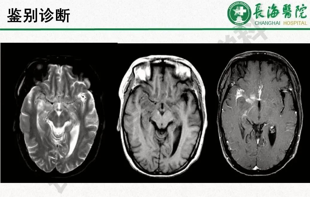 影像PPT - 【PPT】低颅压综合征-41