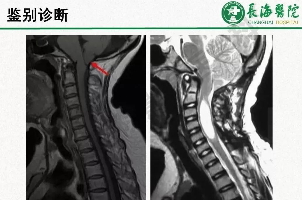 影像PPT - 【PPT】低颅压综合征-44