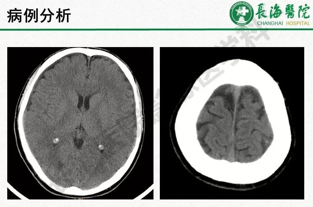 影像PPT - 【PPT】低颅压综合征-47