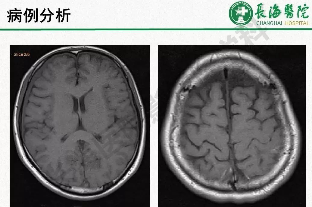 影像PPT - 【PPT】低颅压综合征-48