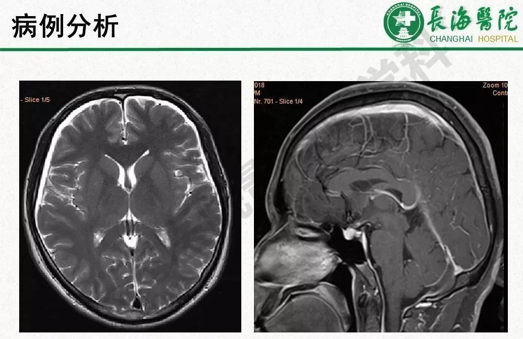 影像PPT - 【PPT】低颅压综合征-49