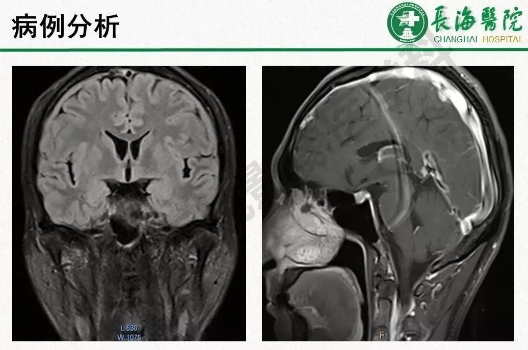 影像PPT - 【PPT】低颅压综合征-51