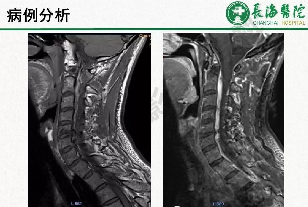 影像PPT - 【PPT】低颅压综合征-52