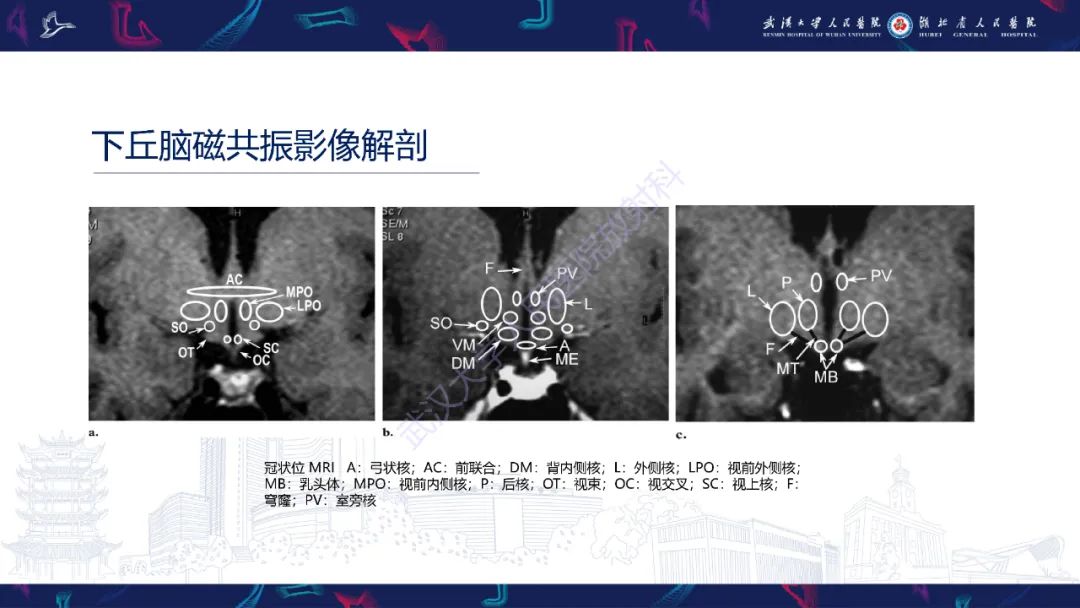 影像PPT - 【PPT】下丘脑错构瘤影像诊断-8