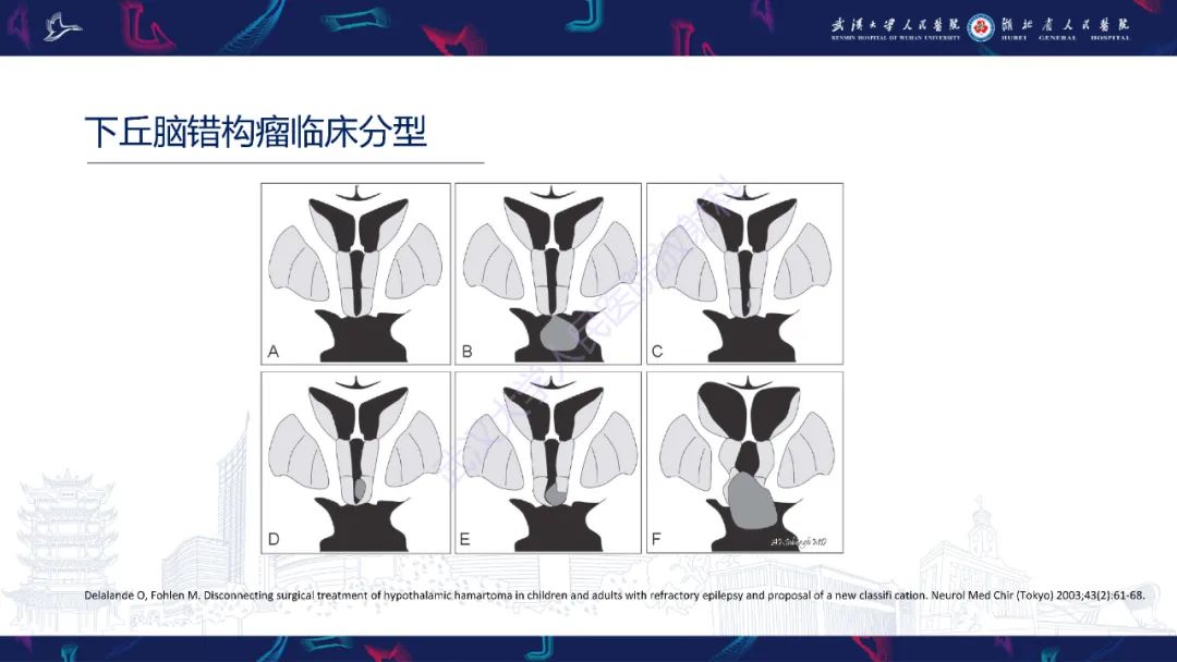 影像PPT - 【PPT】下丘脑错构瘤影像诊断-15