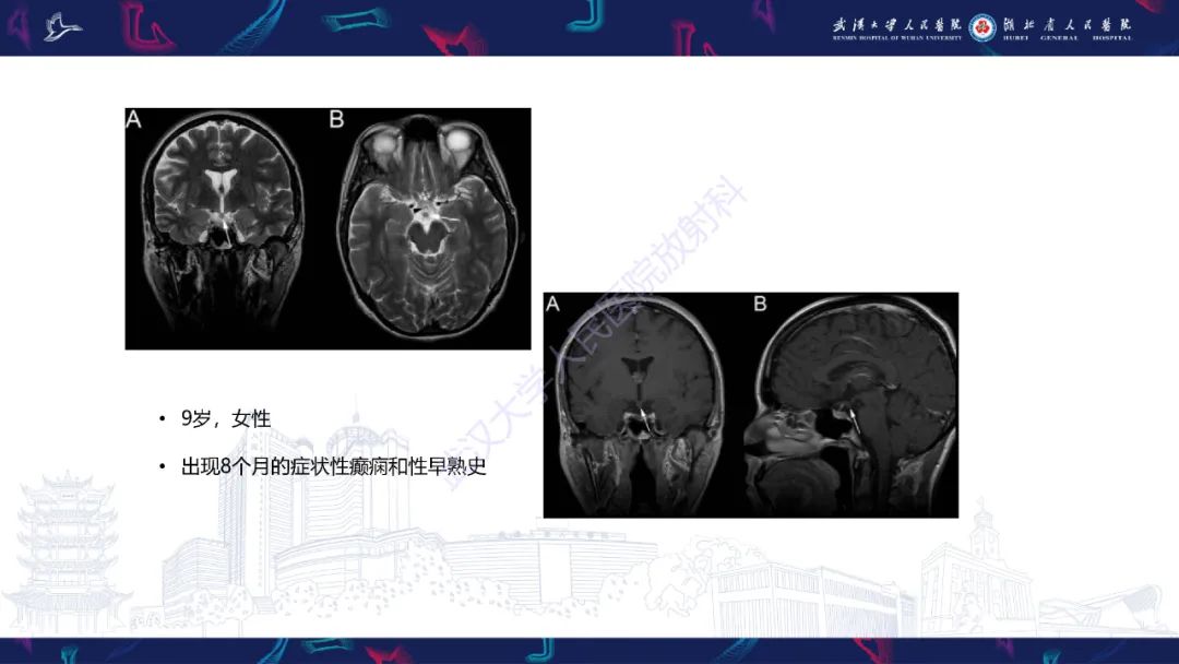 影像PPT - 【PPT】下丘脑错构瘤影像诊断-19