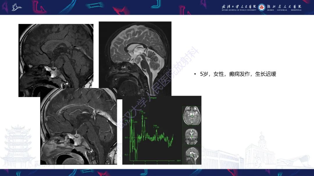 影像PPT - 【PPT】下丘脑错构瘤影像诊断-20