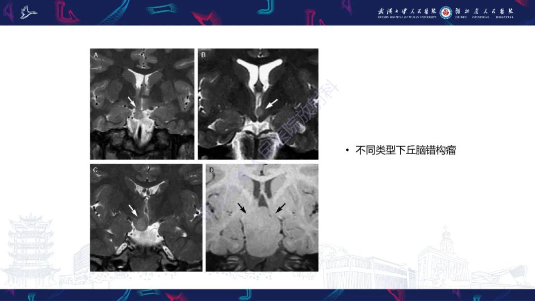 影像PPT - 【PPT】下丘脑错构瘤影像诊断-21