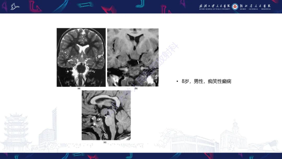 影像PPT - 【PPT】下丘脑错构瘤影像诊断-22