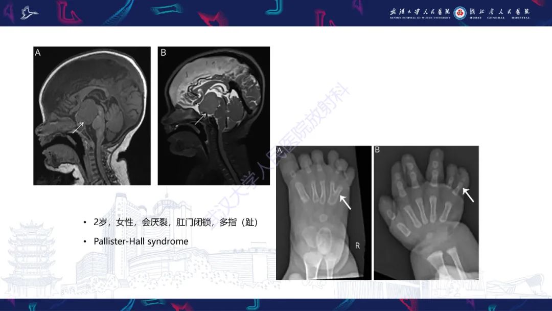 影像PPT - 【PPT】下丘脑错构瘤影像诊断-23